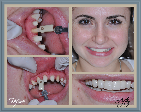 Patient Before and After - Brunilda
