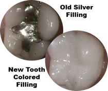 Old silver filling and new tooth colored filling comparison