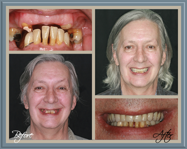 Patient Before and After - Hoffman