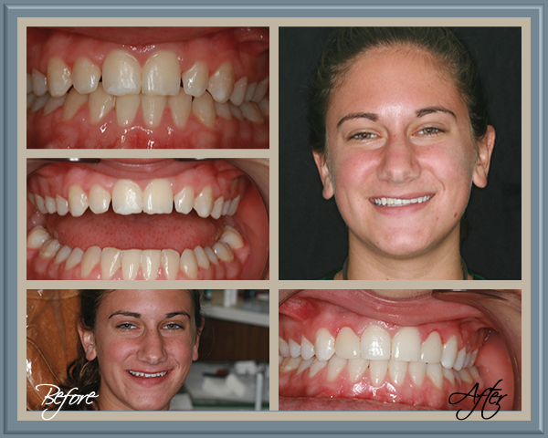 Patient Before and After - Rachel