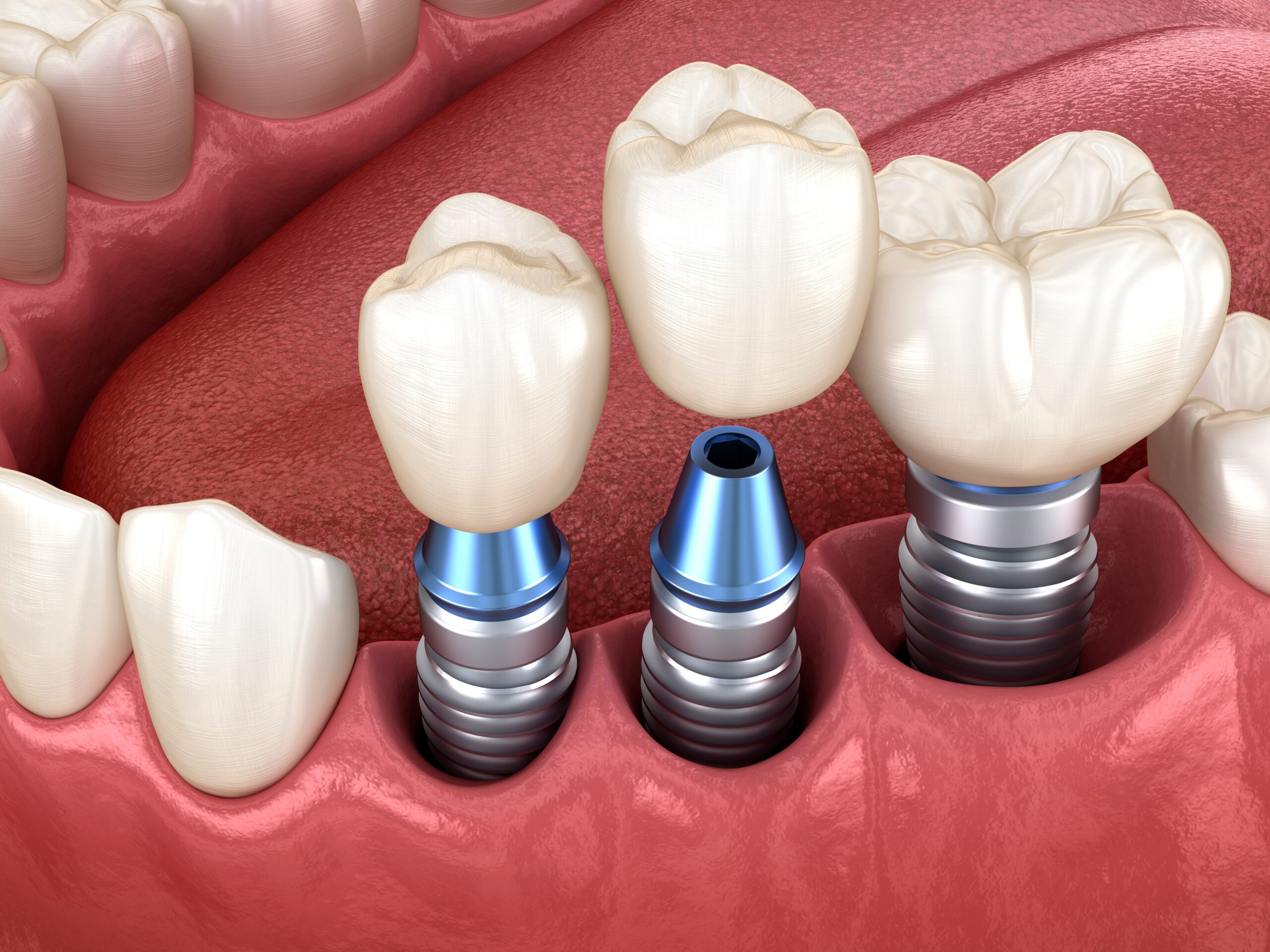 Iti Dental Implants: Planning， Placement， Restoration， and Maintenance [ハードカバー] Wilson， Thomas G.， Jr. Iti Dental Implants: Planning， Placement， Restoration， and