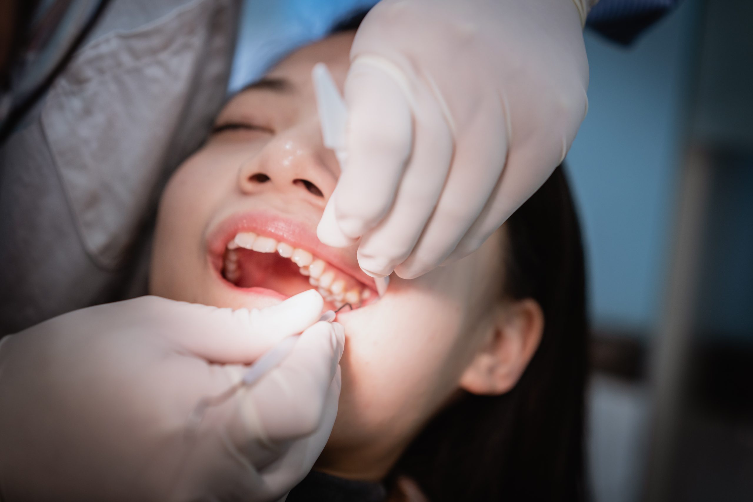 dentist extracting a tooth from a young patients mouth