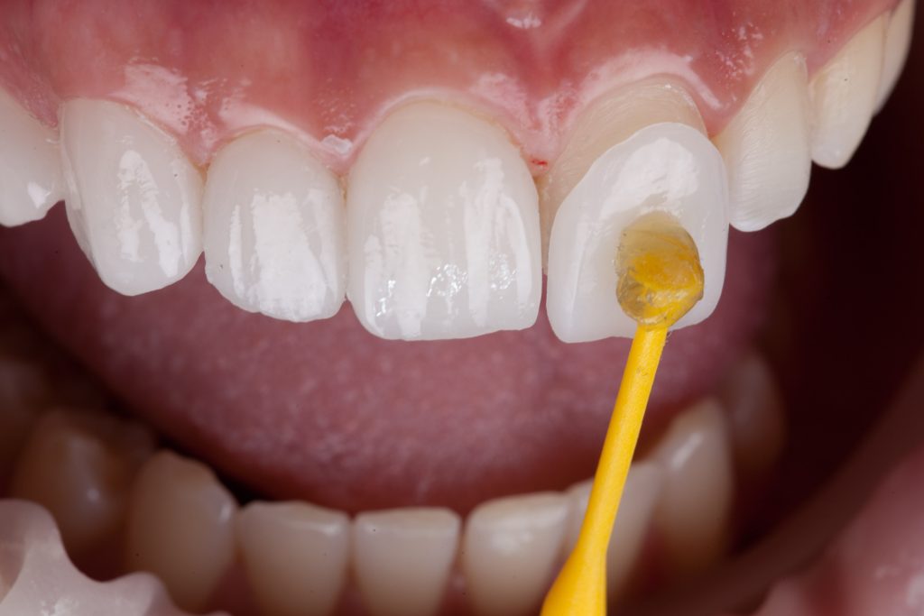 up close application of dental veneers