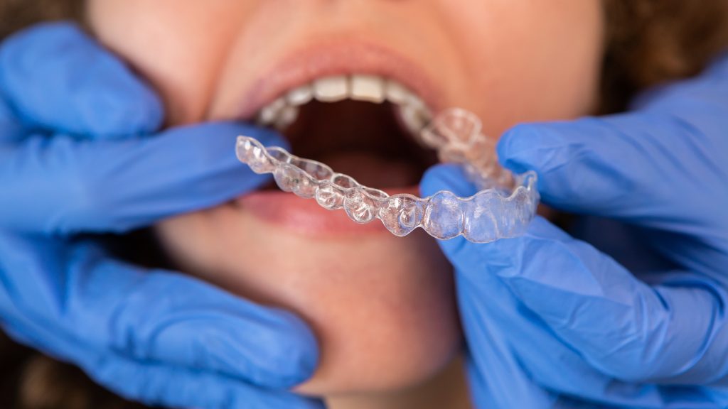 dentist placing a woman's clear aligners in her mouth