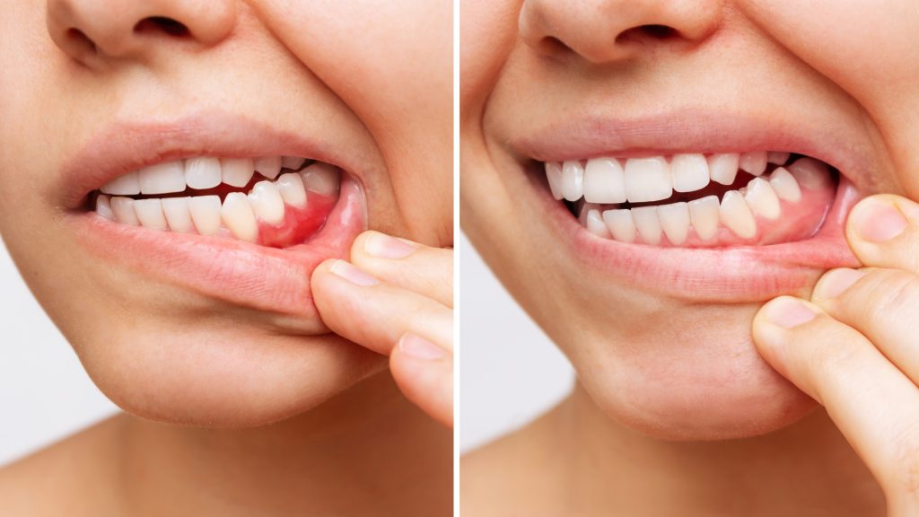 side by side of a patients gums, early signs of gum disease